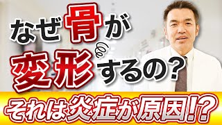 なぜ骨が変形するの？それは炎症が原因？！指の痛みへバーデン結節