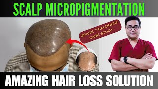 Scalp Micropigmentation Results are MIND-BLOWING! #scalpmicropigmentation