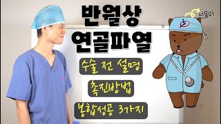 반월상연골파열 2시리즈 4 - 수술 전 설명, 봉합성공 3가지, 촉진방법