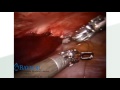 lap inguinal hernia repair tapp with ultrapro advanced™ mesh u0026 stratafix™ spiral dr. steven leeds