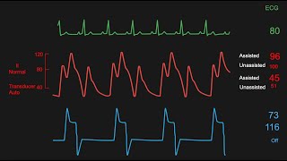 Interpreting the data displayed on a balloon pump console monitor