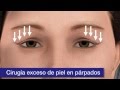 Operación de párpados | Clínica Baviera