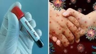 Measles disease  history malayalam | meesles | ancham pani | മീസിൽസ് രോഗ ചരിത്രം | അഞ്ചാം പനി