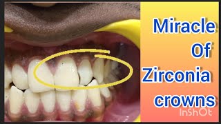 कैपिंग Zirconia Capping ही है इस तरह की कैविटी (Cavity)का परमानेंट सॉल्यूशन #cavity #zirconiacrowns