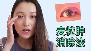 得了麦粒肿怎么办？治疗方法，如何预防日后复发 【D视界】#麥粒腫#热敷疗法