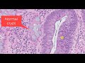 The Diagnosis of a Tubular Adenoma