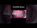 Overbite brace before after #shorts #braces #orthodontist