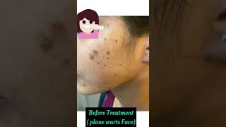 Tretinoin cream |plane warts on face| Does tretinoin works for plane warts alone or with medication