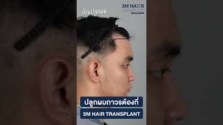 🤤 คุณเต้ Powerpuff Gay X 3M Hair Transplant ✅ หลังปลูกผม ขึ้นจริงไม่ขึ้นทิพย์ แน่น! ถี่! ละเอียด!