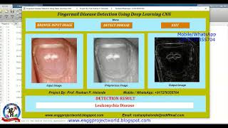 Fingernail Disease Detection Using Deep Learning CNN Matlab Project With Source Code