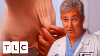 Dr. LoMonaco Has Never Seen This Type Of Excess Skin On Legs Before | My Extreme Excess Skin