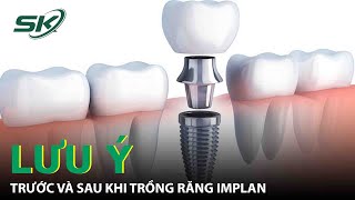 Những Lưu Ý Trước Và Sau Khi Trồng Răng Implant | SKĐS