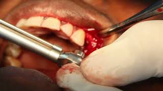 Dental implant /ጥርስን ያለደጋፊ መትከል