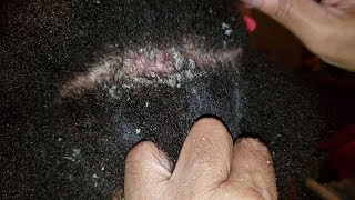 Dandruff Scratching Back View Flaky Scalp