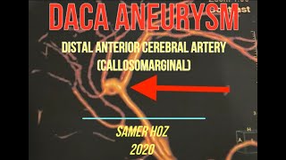 DACA Aneurysm (Distal Anterior cerebral artery - Callosomarginal) Samer Hoz 2020