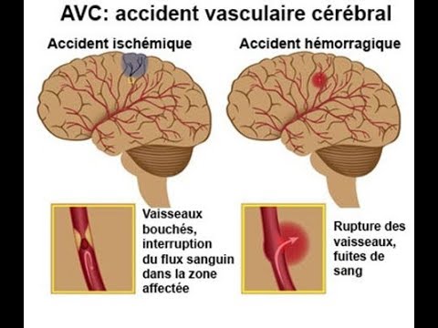 Accident Vasculaire Cérébral - YouTube