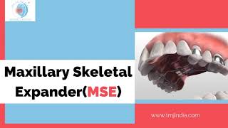 Maxillary Skeletal Expander: How it Works?| Best Maxillary Skeletal Expander Bengaluru| Dr Rajesh