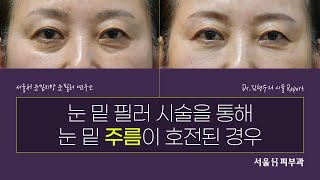 Treating Fine Wrinkles Around the Eyes with Under-Eye Fillers