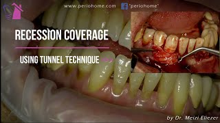 Recession Coverage Tunnel Technique With Connective Tissue Graft