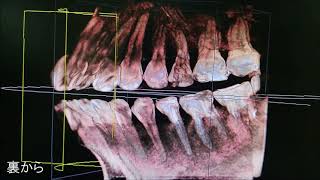 宮崎歯科医院　ＣＴのご説明　虎ノ門内幸町霞ヶ関新橋の歯医者　精密根管治療　ｲﾝﾌﾟﾗﾝﾄ治療　マイクロスコープ