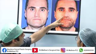 WHAT YOU NEED TO KNOW ABOUT NOSE CORRECTION SURGERY (RHINOPLASTY) : NOSE CORRECTION EXPLAINED