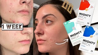 TESTING HERO MIGHTY PATCH \u0026 MICRO POINT ACNE PATCHES ON MY HORMONAL ACNE FOR 1 WEEK