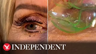 Doctor removes 23 contact lenses from patient’s eye