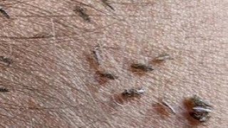 Heavy Egg lice | Nits Removal with Real Girl #heavyegglice #removal