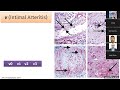 renal tx allograft rejection part 2