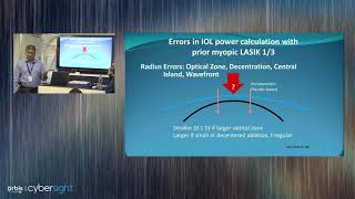 Lecture: IOL Power Calculation in Post-Myopic LASIK/RK Eyes: Dr. Jay Bansal