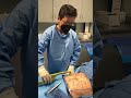 Removal of Subcutaneous Fat from Abdomen