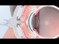 LipiFlow System for Dry Eye Treatment