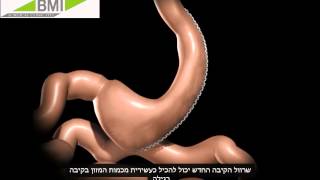 קיצור קיבה: ניתוח שרוול   http://www.bmimed.co.il