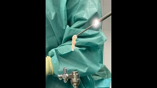 Lumbar disc herniation L5-S. Full endoscopic interlaminar approach (Discectomy)