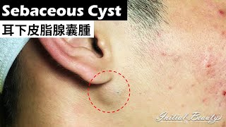 耳下皮脂腺囊腫( sebaceous cyst under ear ) - Taiwan Tainan台南清粉刺最乾淨