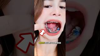 The Painful Truth About Braces Springs!