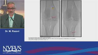 Hydrodynamic thrombectomy How a uniquely positioned saline jet provides efficiency and safety Razavi