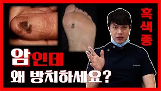 암에 걸렸는데 그냥 놔두실 건가요? 악성 흑색종! I 점과 구별하는 방법, 종류