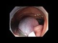 Colonoscopy Gone Awry - Asc col emr bleeding clip - Case 1a