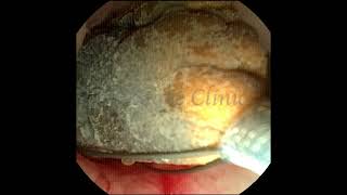 Kidney Stone Basket in the Upper Ureter.