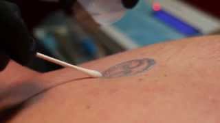 Joey's Social Trends: Tattoo Removal and Micro-needling