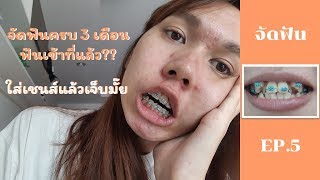 ใส่เชนจัดฟันเจ็บไหม??? จัดฟัน3เดือนฟันเข้าแล้ว??? | bbingbig