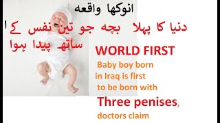 World first Baby boy born with three penises in Iraq