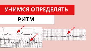 Учимся определять ритм. Пошаговая инструкция и ЭКГ примеры. Анализ ЭКГ.