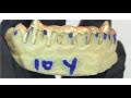 Custom Diamond Dust Drip Fang Grillz