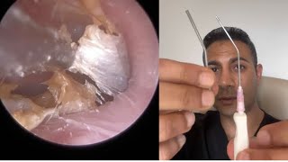 1,510 - Extremely Itchy Dead Skin Accumulation Removed from Ear | Learn About Zo