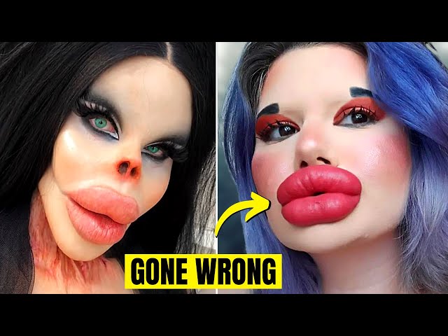 Botox Lips Gone Bad Infoupdate Org
