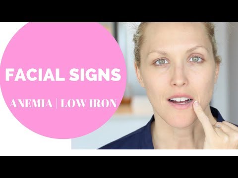 FACIAL SIGNS OF ANEMIA, LOW IRON | HEAVY PERIODS FACIAL SIGNS OF ANEMIA, LOW IRON | HEAVY PERIODS