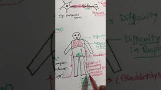 Gullain Barre Syndrome(বাংলা)