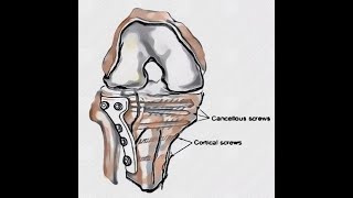 Anterolateral Approach to the Lateral Tibial Plateau.